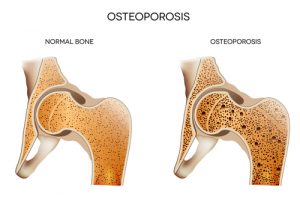 Osteoporosis Picture of Bones